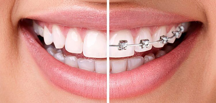 Braces vs. Invisalign mouth side-by-side