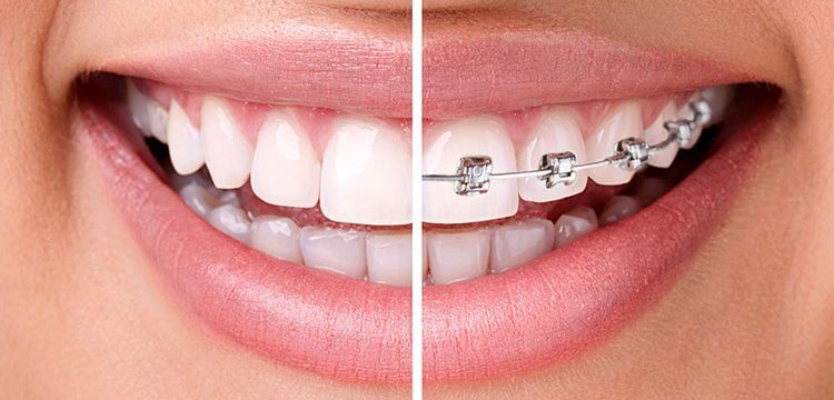 Braces vs. Invisalign