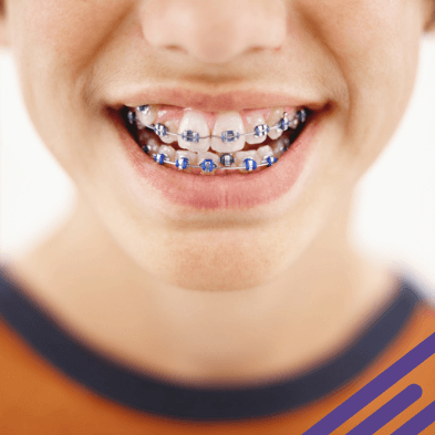 Braces Cost close-up of blue braces