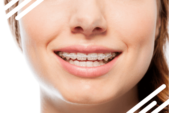 Close-up of girl with clear clear ceramic braces