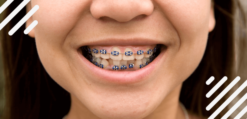 How much are braces with insurance?