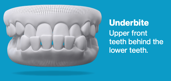 What is an underbite? - Invisalign graphic