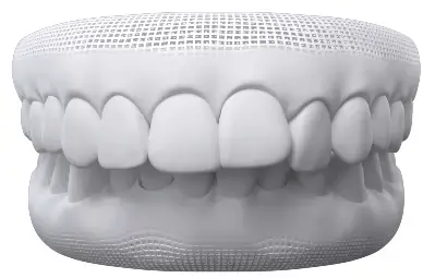 Digital smile of an overbite where the top front teeth overlap the bottom teeth